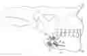 Fig. 01 - Curve linear and straight mandibular distractor with occlusion correction feature