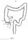 Fig. 02 - Apparatus and method for colonoscopic appendectomy
