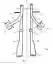 Fig. 04 - Apparatus and method for colonoscopic appendectomy