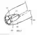 Fig. 07 - Apparatus and method for colonoscopic appendectomy