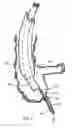Fig. 08 - Apparatus and method for colonoscopic appendectomy