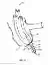Fig. 09 - Apparatus and method for colonoscopic appendectomy