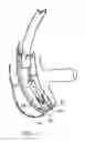 Fig. 12 - Apparatus and method for colonoscopic appendectomy