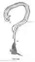 Fig. 28 - Apparatus and method for colonoscopic appendectomy