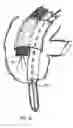 Fig. 29 - Apparatus and method for colonoscopic appendectomy