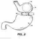 Fig. 05 - Methods and devices for maintaining a space occupying device in a relatively fixed location within a stomach