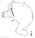Fig. 06 - Methods and devices for maintaining a space occupying device in a relatively fixed location within a stomach