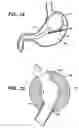 Fig. 08 - Methods and devices for maintaining a space occupying device in a relatively fixed location within a stomach