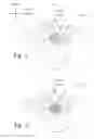Fig. 02 - TISSUE EXCISION DEVICES AND METHODS