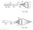 Fig. 43 - Embolic protection system