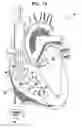 Fig. 02 - Signal delivery through the right ventricular septum