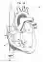 Fig. 03 - Signal delivery through the right ventricular septum