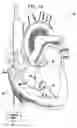 Fig. 04 - Signal delivery through the right ventricular septum