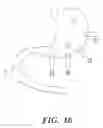 Fig. 12 - Gastrointestinal electrical stimulation