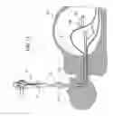 Fig. 19 - Method for accessing abdominal cavity and medical procedure via natural orifice