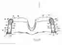 Fig. 10 - Patient interface device with dampening cushion