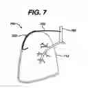 Fig. 06 - Variable resistance pulmonary ventilation bypass valve and method