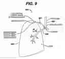 Fig. 08 - Variable resistance pulmonary ventilation bypass valve and method