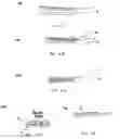 Fig. 02 - Dermabrasion composition and process