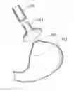 Fig. 01 - Extracellular matrix based gastroesophageal junction reinforcement device