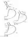 Fig. 05 - Extracellular matrix based gastroesophageal junction reinforcement device