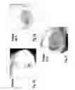 Fig. 02 - Use of factor XIII for stimulating the perfusion of ischemic tissue
