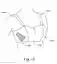 Fig. 14 - Helical brachytherapy apparatus and methods of using same