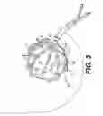 Fig. 03 - Expandable brachytherapy device