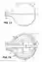 Fig. 10 - Expandable brachytherapy device