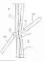 Fig. 01 - Magnetic stabilization of catheter location sensor