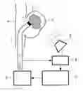 Fig. 01 - Catheter, apparatus and method for therapeutic embolization