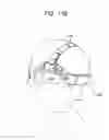Fig. 23 - Ultrasound emitting device comprising a head frame