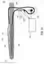 Fig. 08 - Method and apparatus for protecting the rectal wall during cryoablation