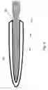 Fig. 09 - Method and apparatus for protecting the rectal wall during cryoablation