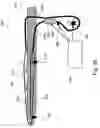 Fig. 06 - Method and apparatus for protecting the rectal wall during cryoablation