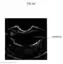 Fig. 11 - ULTRASOUND IMAGING SYSTEM FOR EXTRACTING VOLUME OF AN OBJECT FROM AN ULTRASOUND IMAGE AND METHOD FOR THE SAME