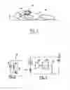 Fig. 02 - Non-invasive detection of the occurrence of apneae or hypopneae in a patient