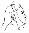 Fig. 01 - Method for improving the appearance of the submandibular area of the human face
