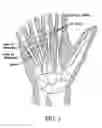 Fig. 02 - Digit pad and method for treating trigger finger and trigger thumb