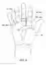 Fig. 04 - Digit pad and method for treating trigger finger and trigger thumb