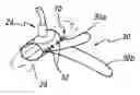 Fig. 01 - Methods and devices for tensioning a wrap around a blood vessel