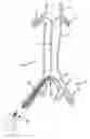 Fig. 01 - VASCULAR SHEATH WITH VARIABLE LUMEN CONSTRUCTION