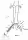 Fig. 03 - VASCULAR SHEATH WITH VARIABLE LUMEN CONSTRUCTION