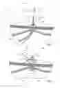 Fig. 05 - Short wire PEG and PEG-J tube