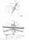 Fig. 06 - Short wire PEG and PEG-J tube