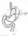 Fig. 07 - Short wire PEG and PEG-J tube