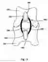 Fig. 11 - Spinal stabilization device