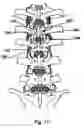 Fig. 16 - Spinal stabilization device