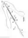 Fig. 56 - Articulating suturing device and method