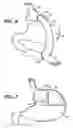 Fig. 04 - Methods and devices for maintaining a space occupying device in a relatively fixed location within a stomach